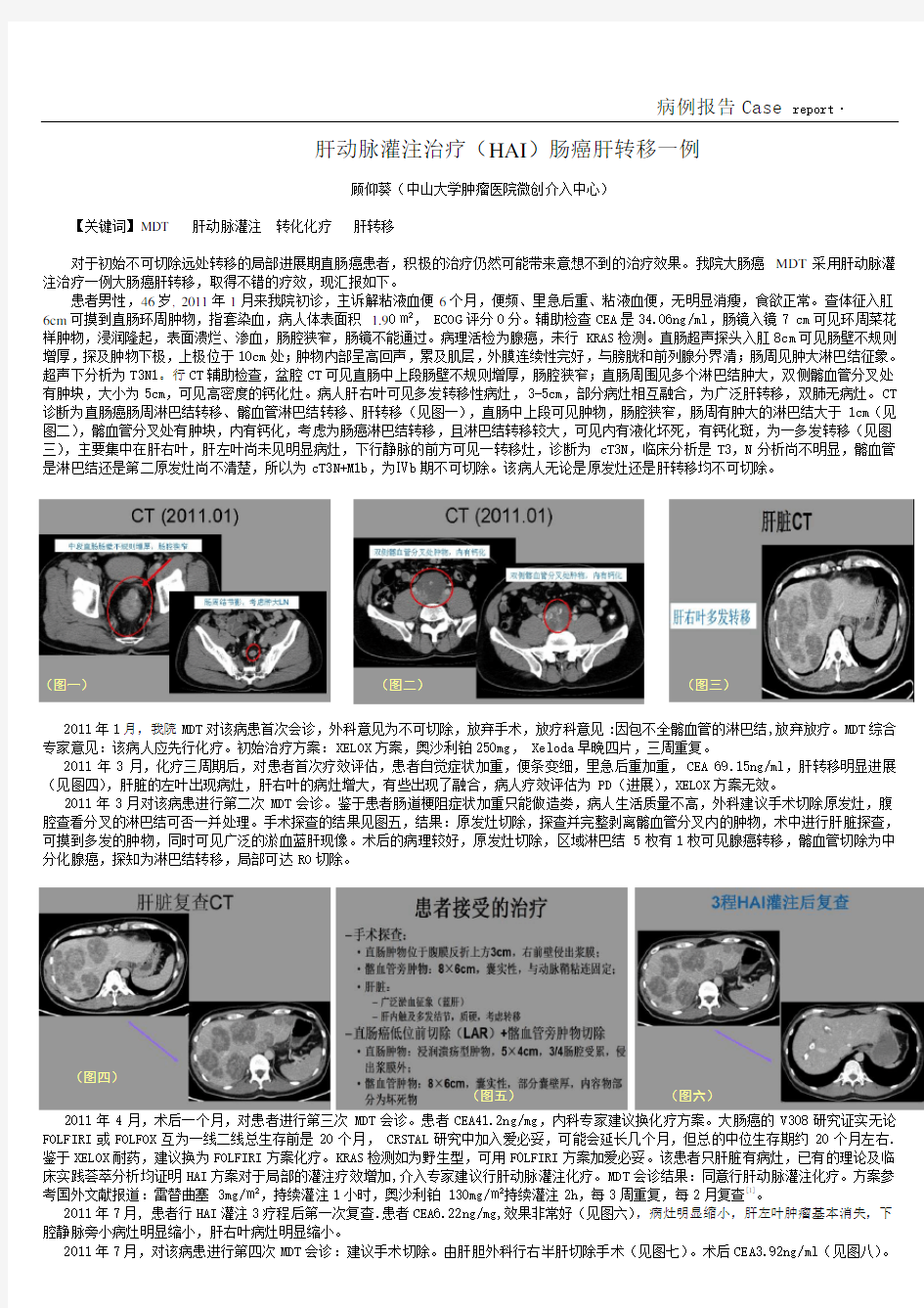 肝动脉灌注治疗(HAI)肠癌肝转移一例