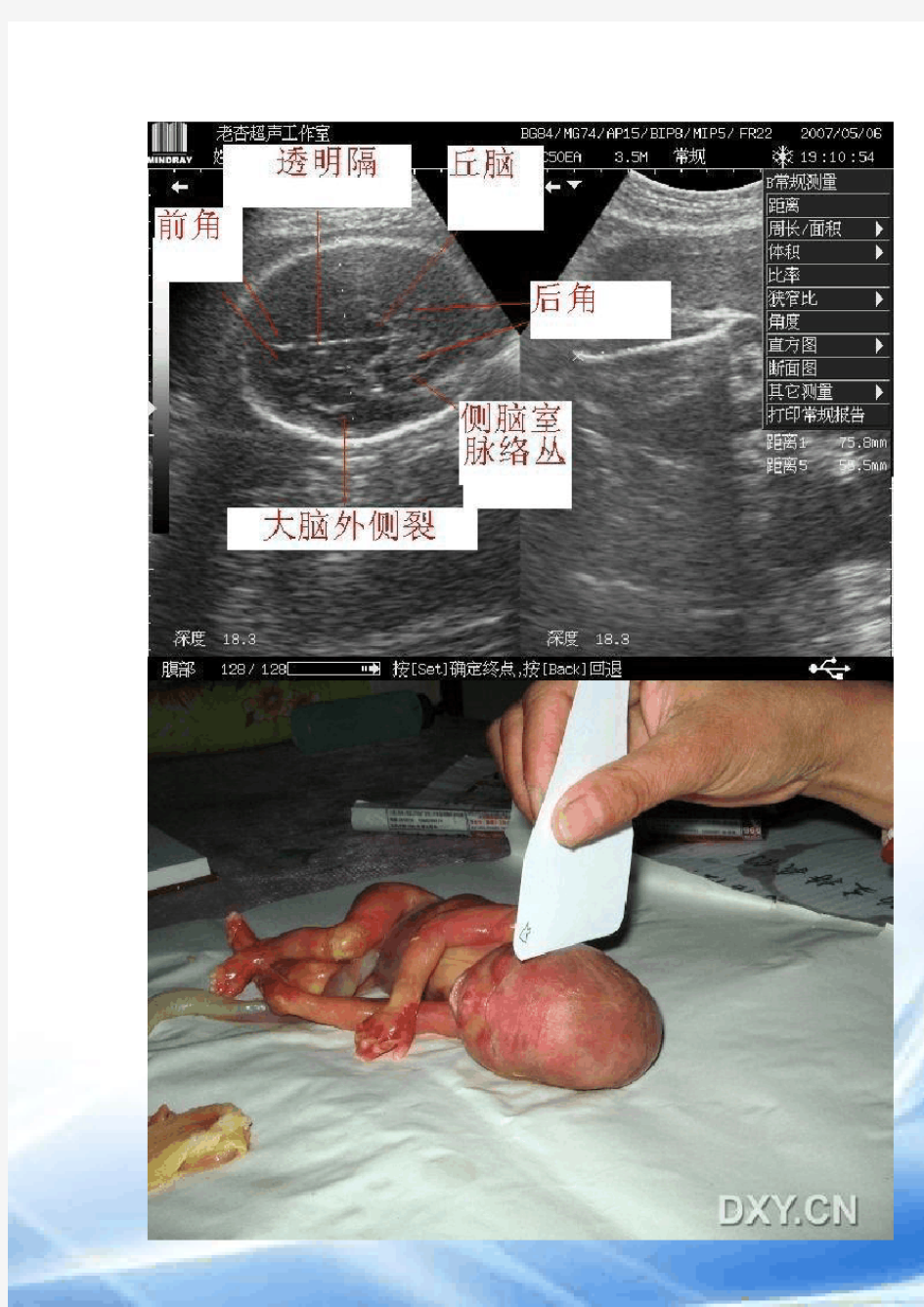 胎儿超声检查常用切面及检查方法(购买的)