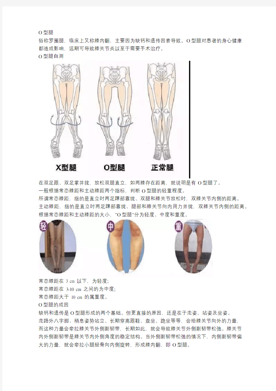 O型腿看过来,这里有一份矫正指南等你查看!