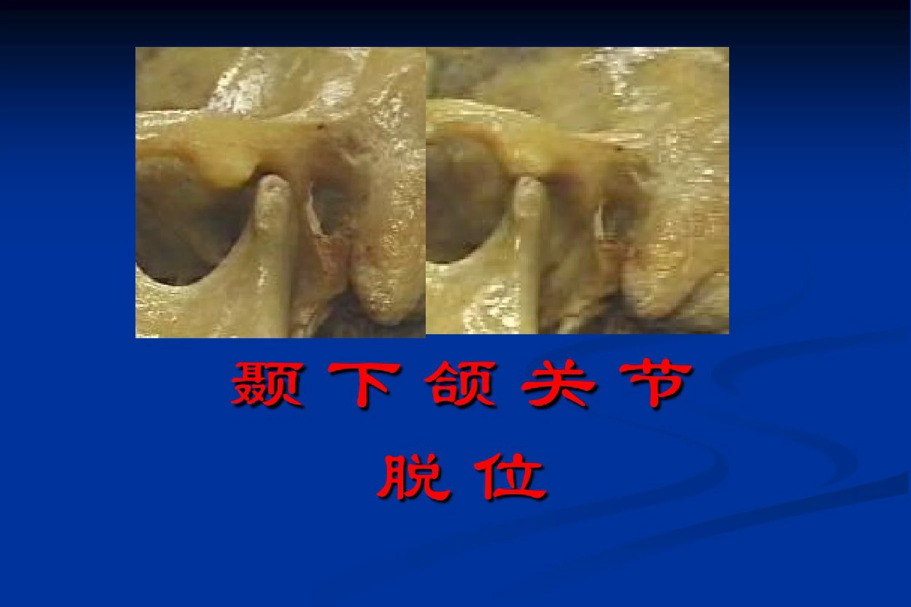 口腔颌面外科学颞颌关节脱位