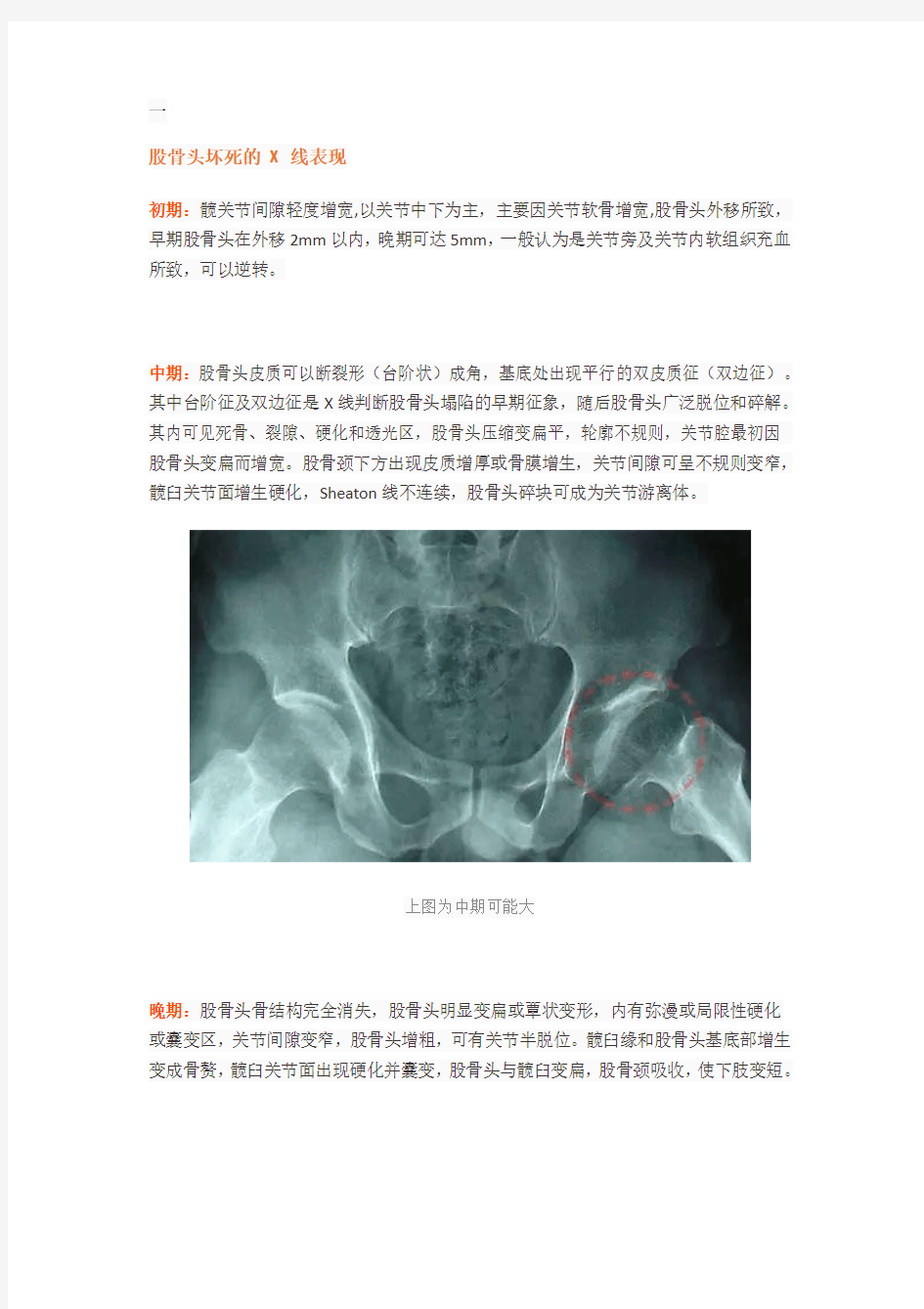 股骨头坏死的X、CT、MRI的影像诊断!