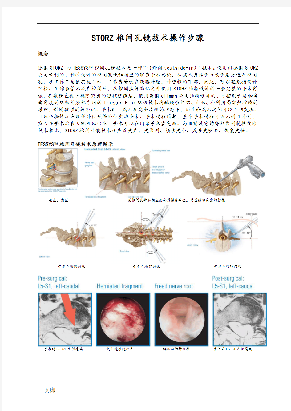 全部步骤(椎间孔镜)手术