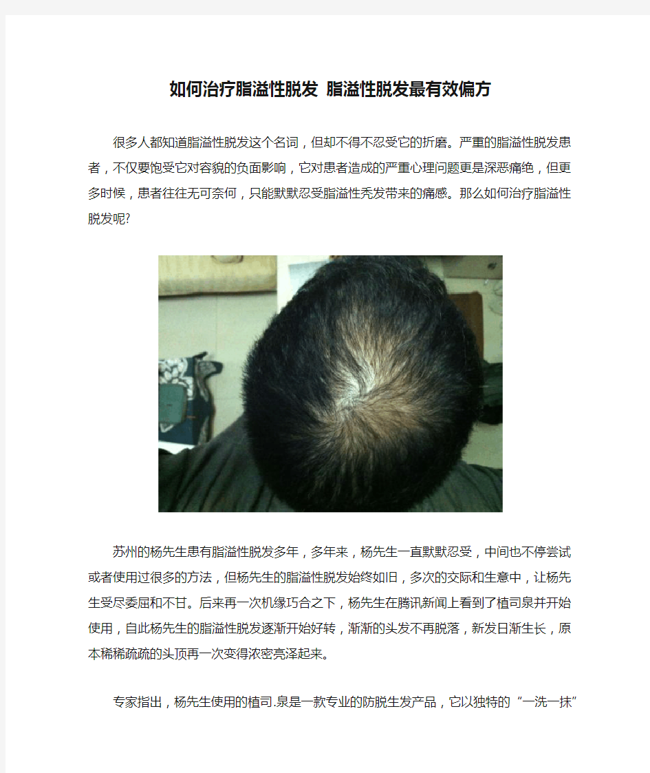 如何治疗脂溢性脱发 脂溢性脱发最有效偏方