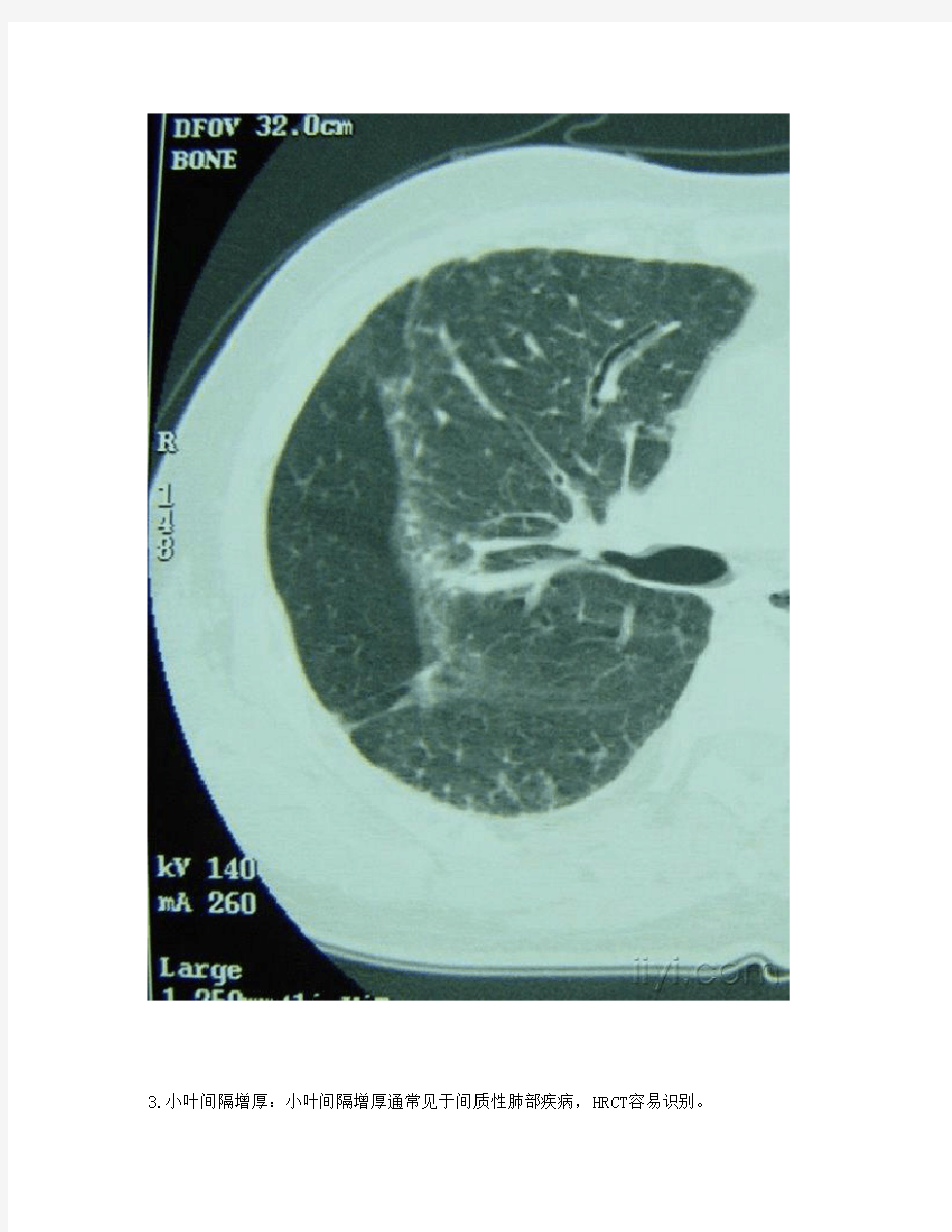 肺部CT征象(大量图片)
