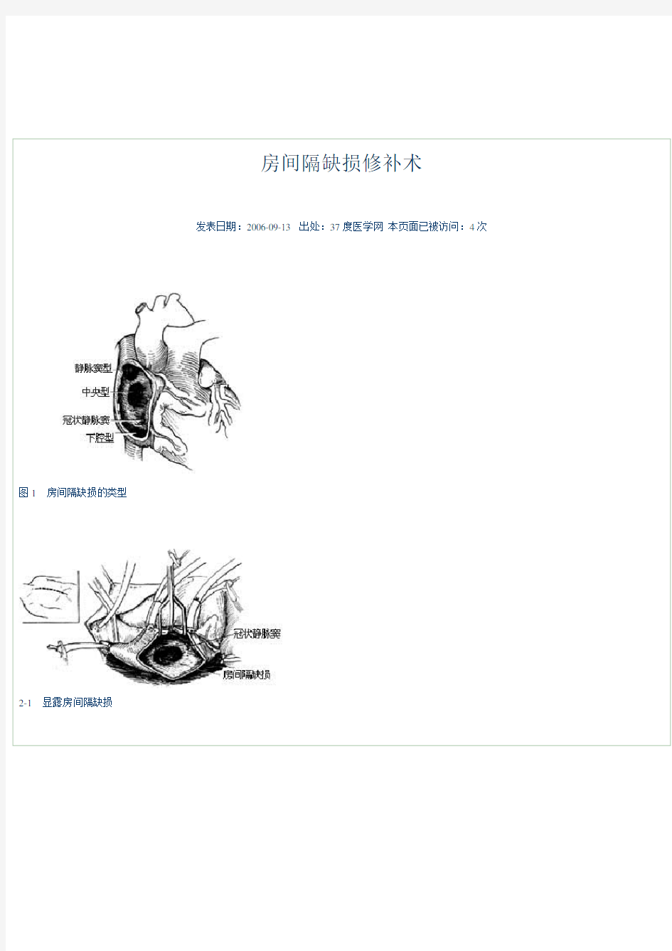 房间隔缺损修补术