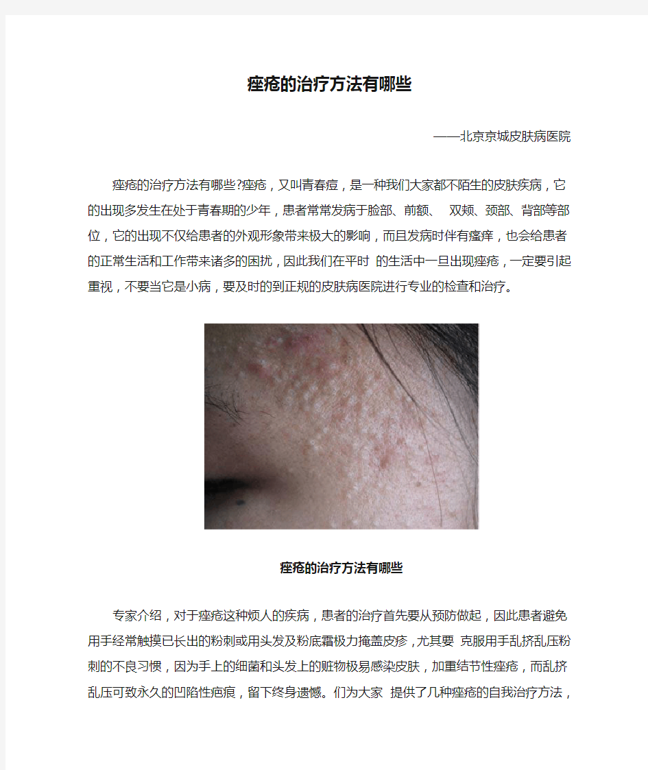 痤疮的治疗方法有哪些