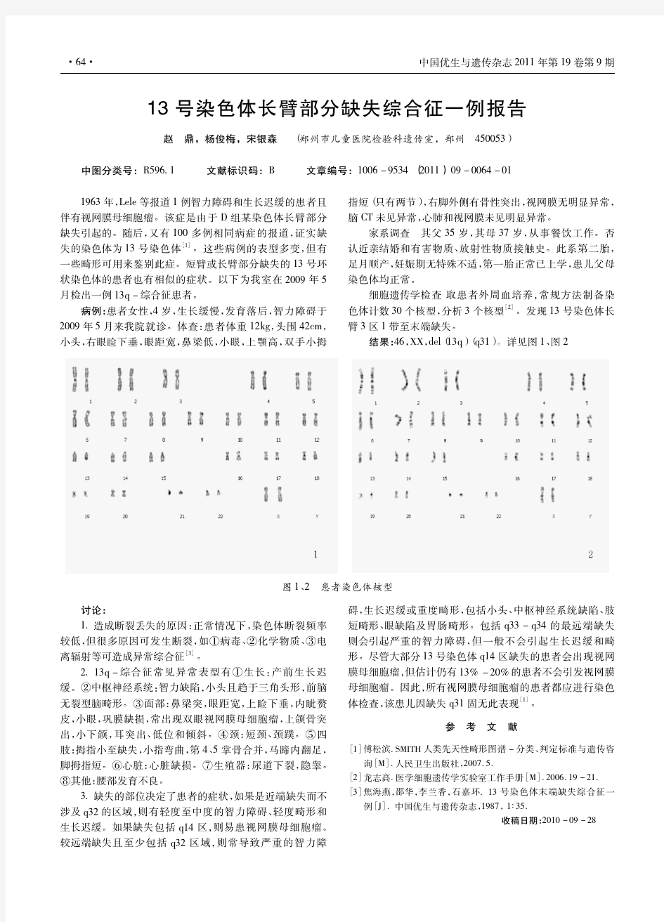 13号染色体长臂部分缺失综合征一例报告