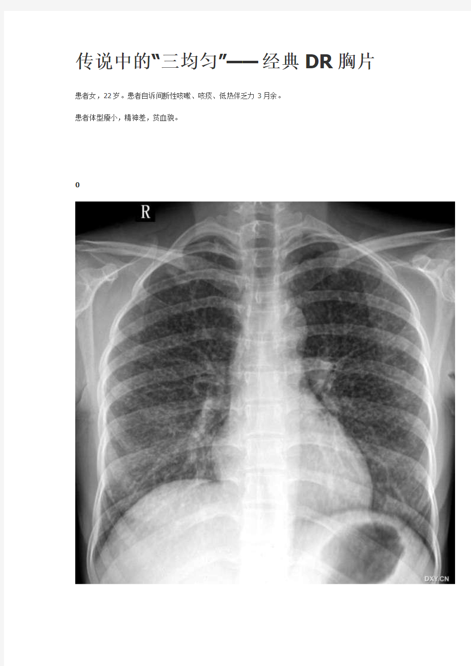 传说中的“三均匀”——经典DR胸片