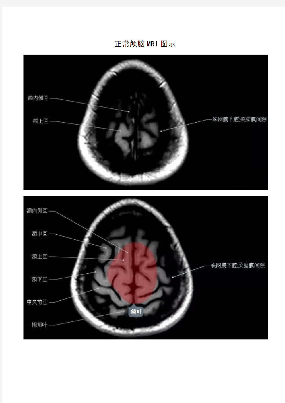 正常颅脑磁共振图示