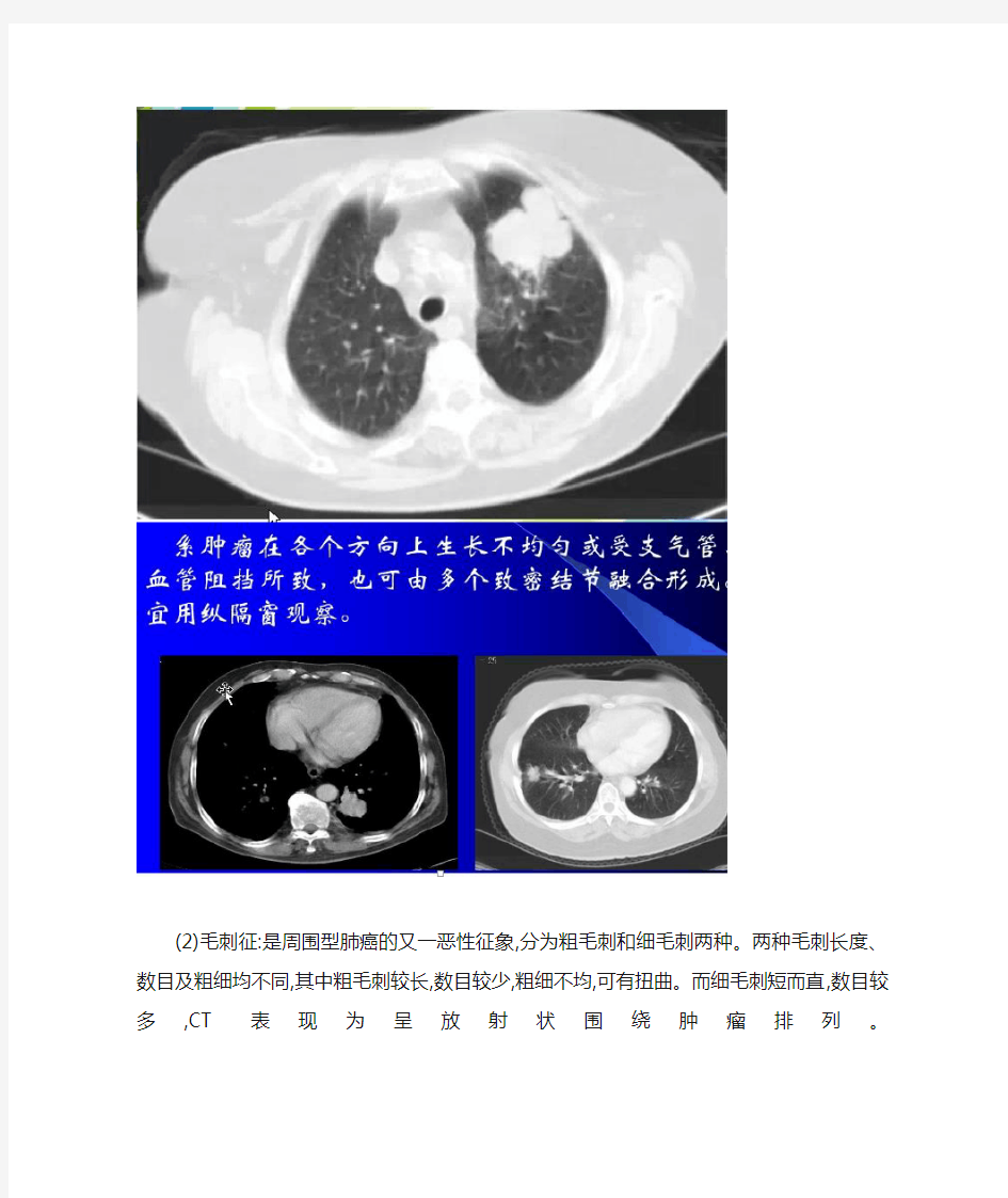 周围型肺癌的CT诊断与鉴别诊断