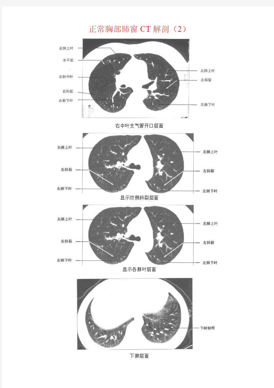 正常胸部CT解剖(肺窗和纵隔窗)