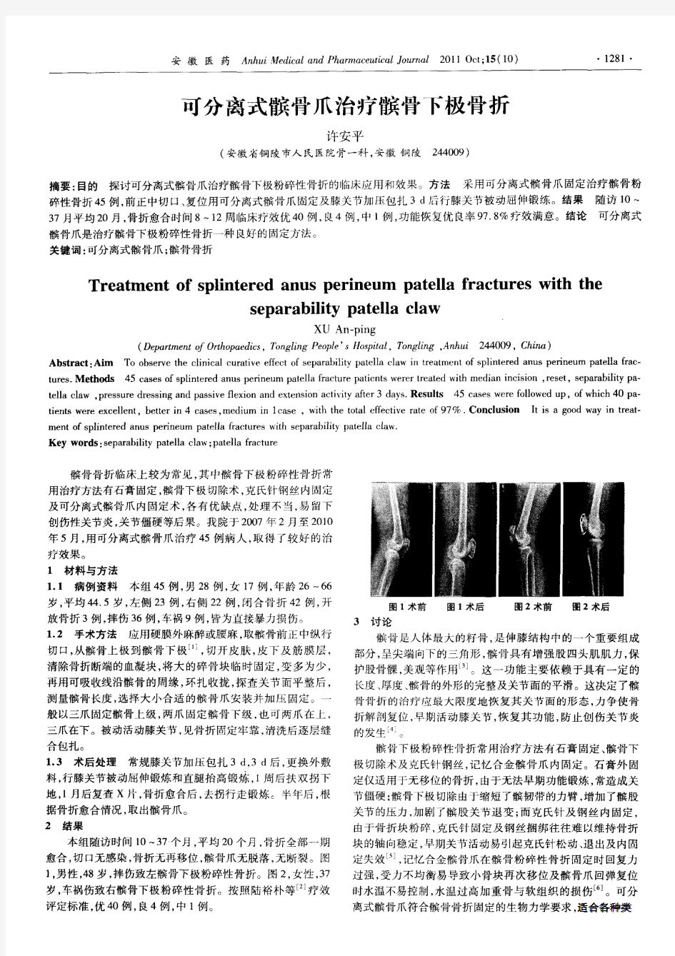 可分离式髌骨爪治疗髌骨下极骨折