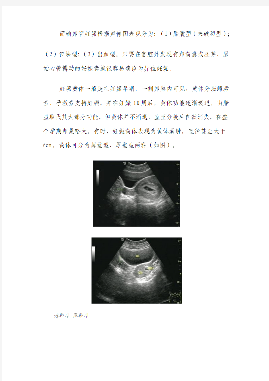 未破裂型输卵管妊娠与妊娠黄体的超声鉴别诊断