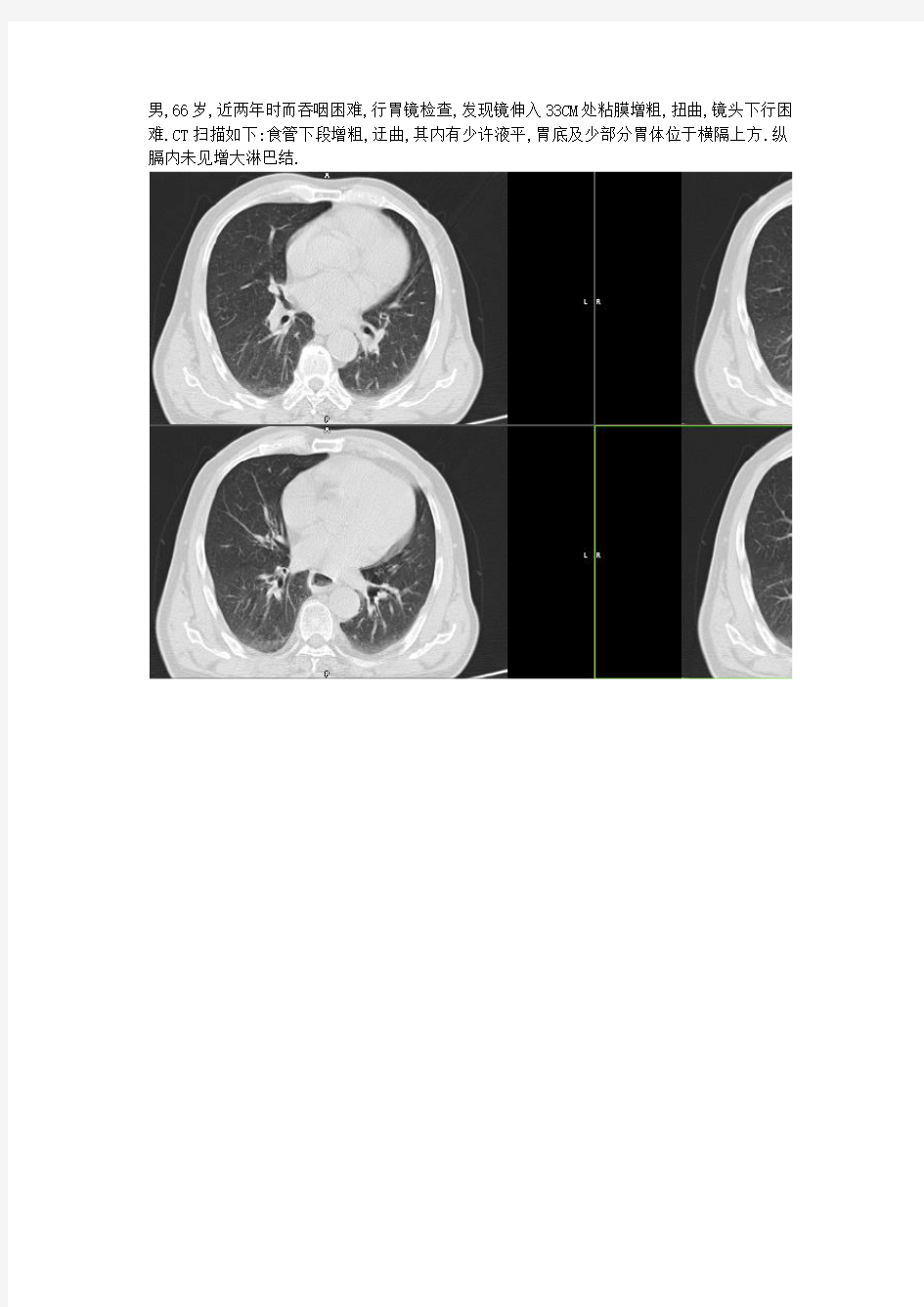食管裂孔疝CT表现