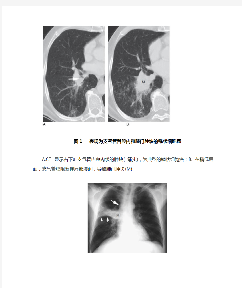 5类肺癌的影像学表现