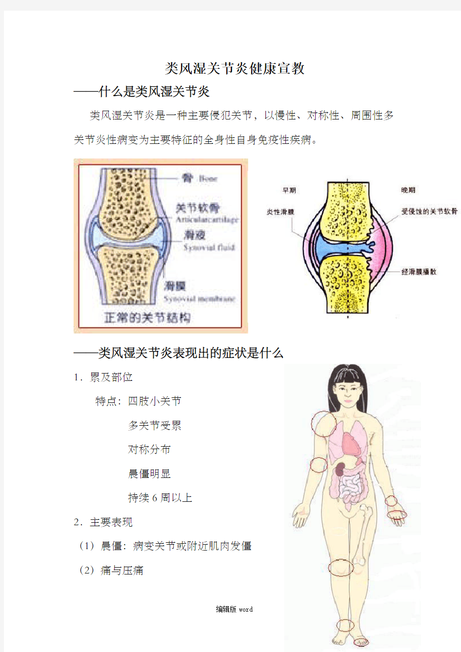 类风湿关节炎健康宣教模板