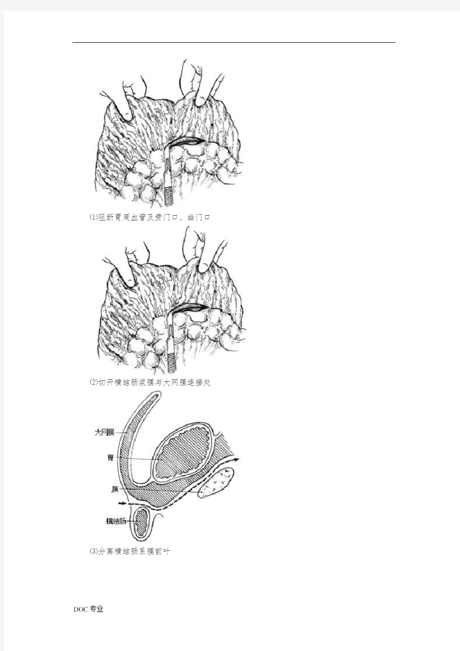 胃癌根治术全过程图解与手术常识1