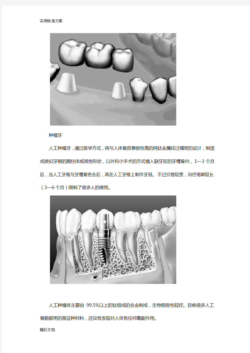 假牙种植牙结构种植体系统种植牙常用材料