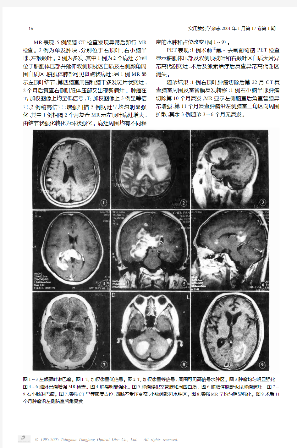 原发性脑淋巴瘤的影像诊断