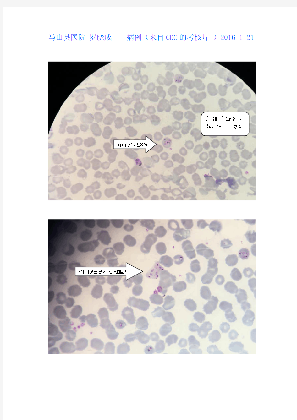 疟原虫的病例 2016-1-21