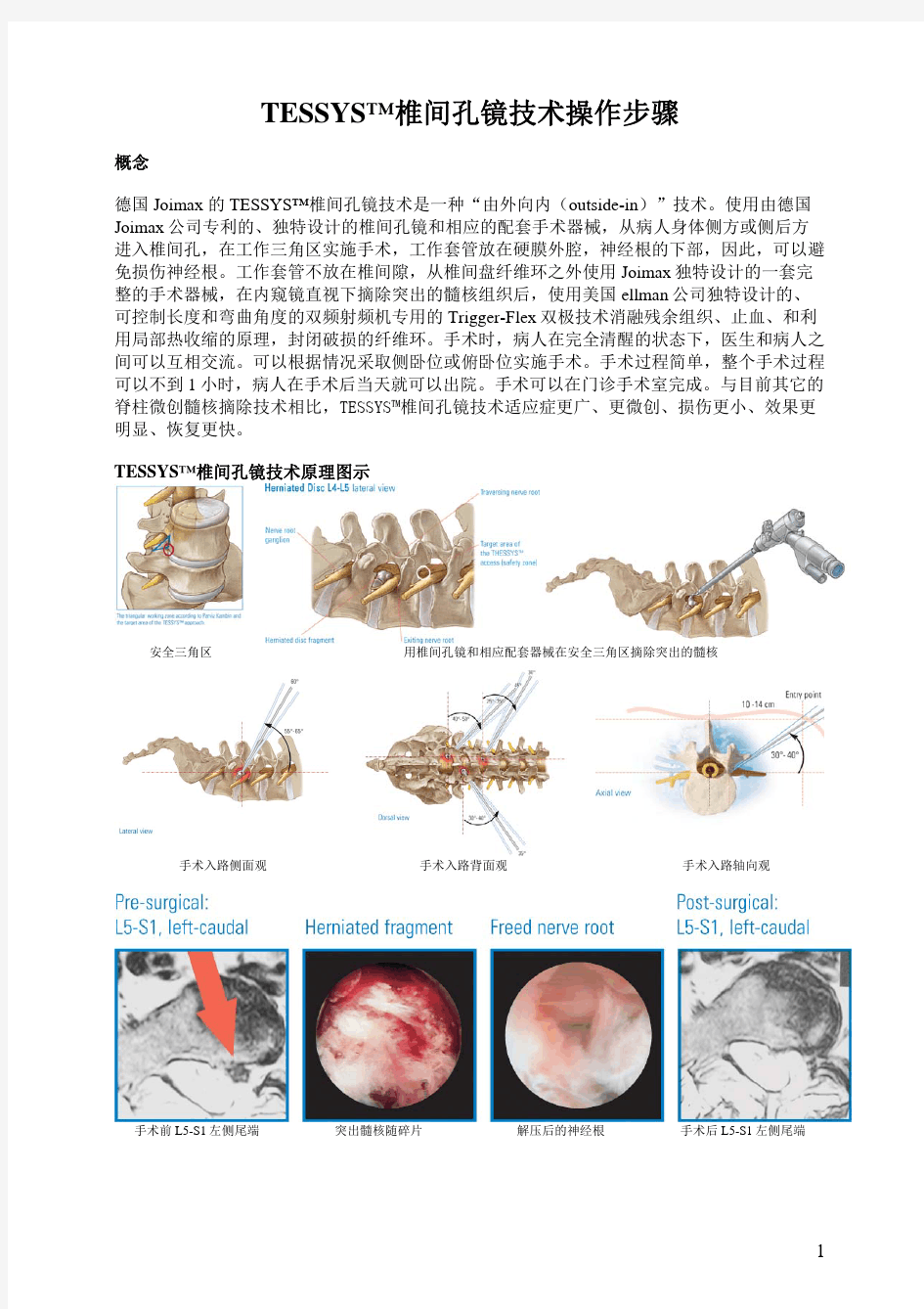 TESSYS技术手术步骤(中文)pdf