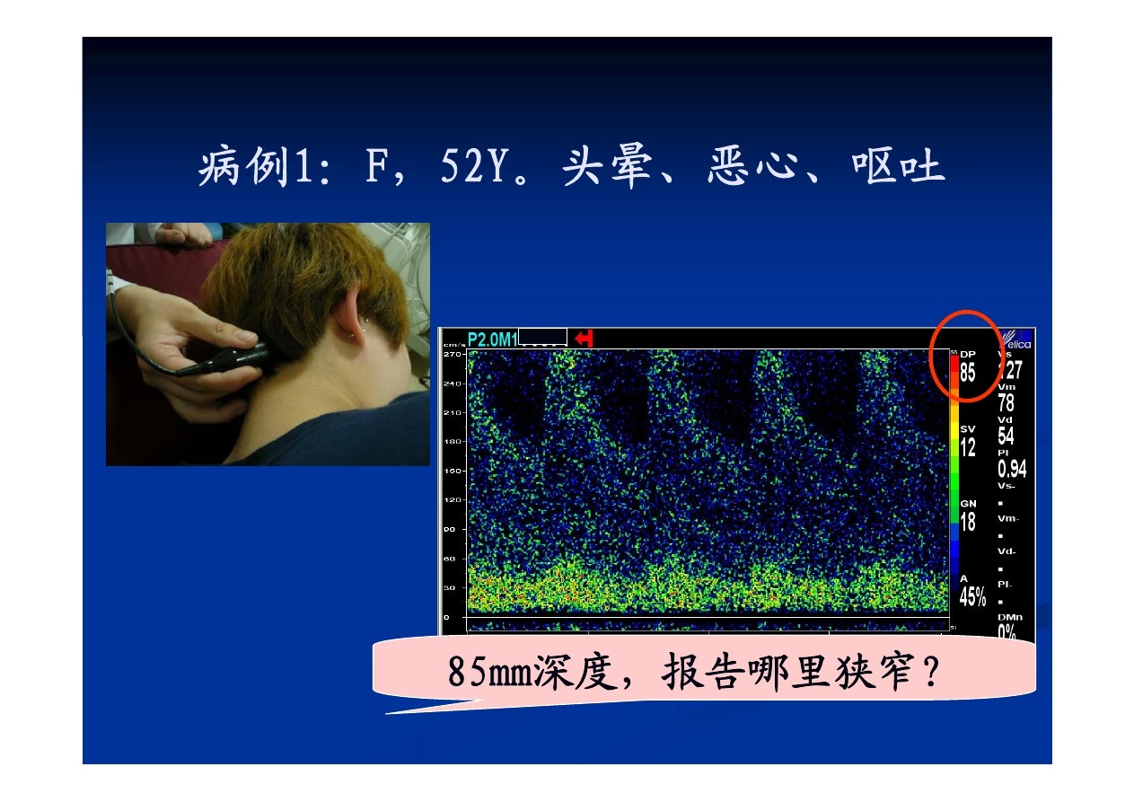 彩色多普勒超声在头颈部血管的应用