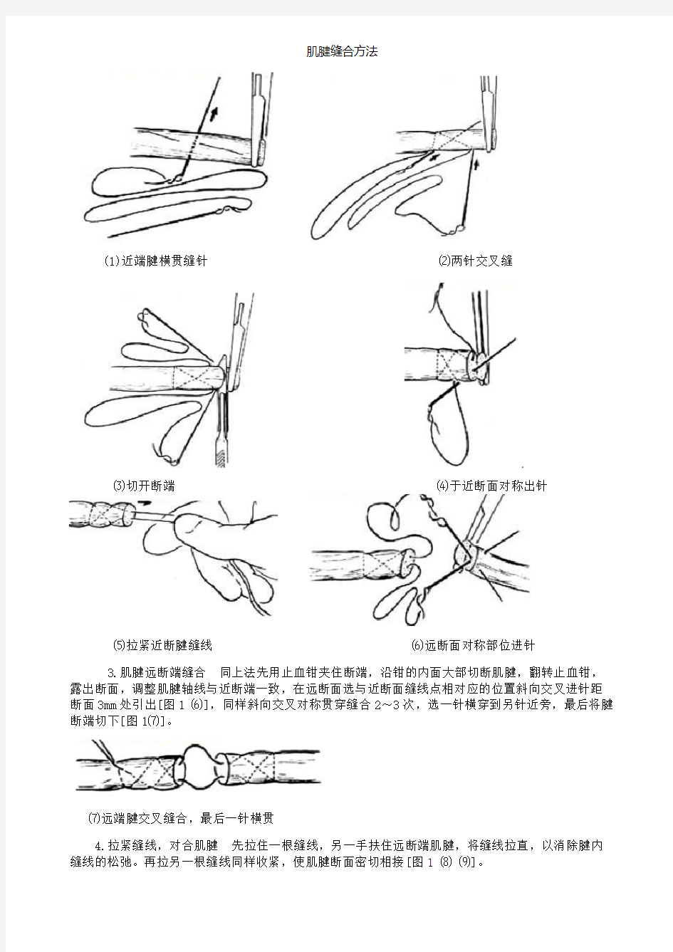 肌腱缝合方法