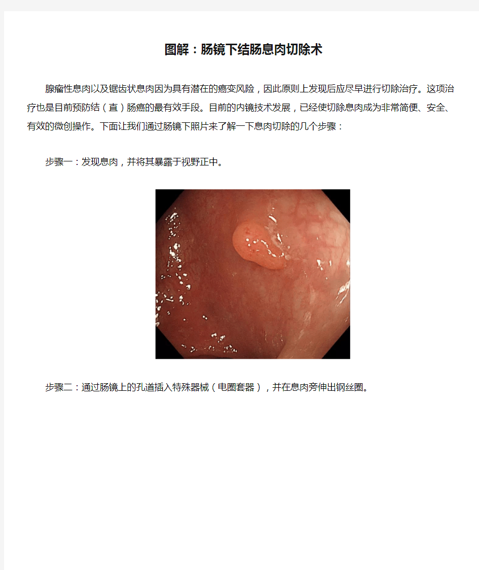 图解：肠镜下结肠息肉切除术