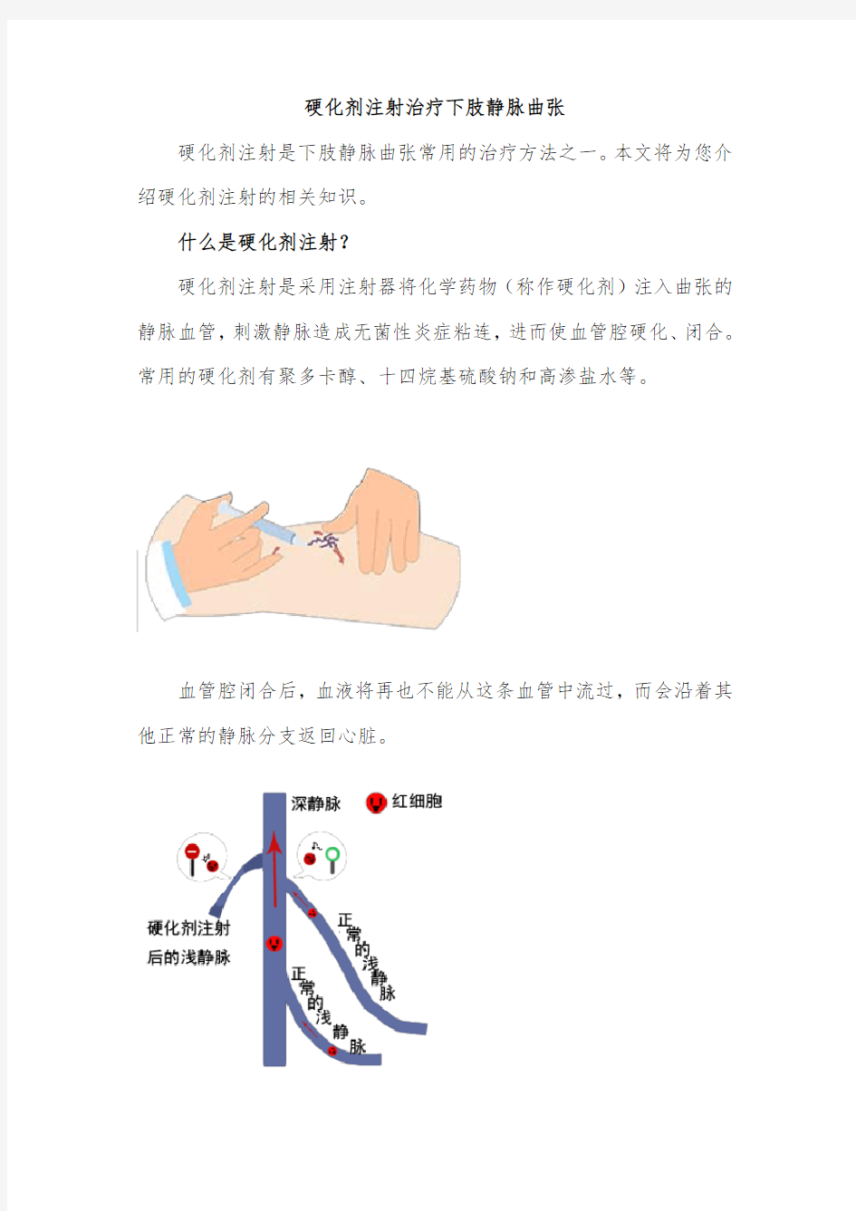 硬化剂注射治疗下肢静脉曲张