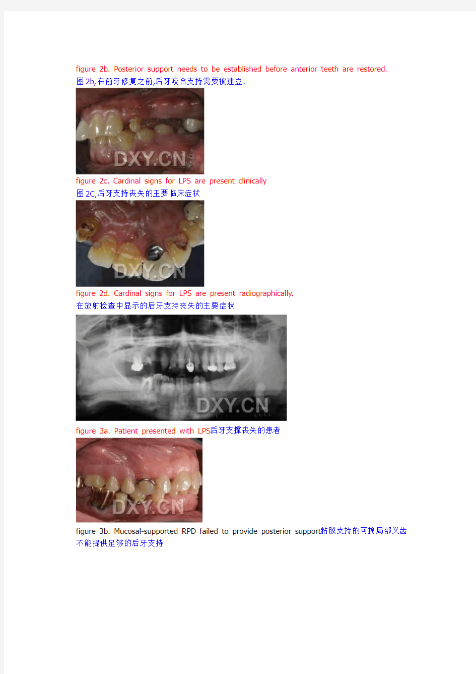 后牙咬合对前牙修复的影响