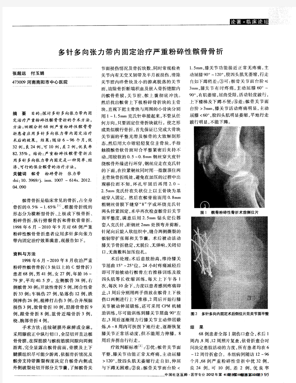 多针多向张力带内固定治疗严重粉碎性髌骨骨折