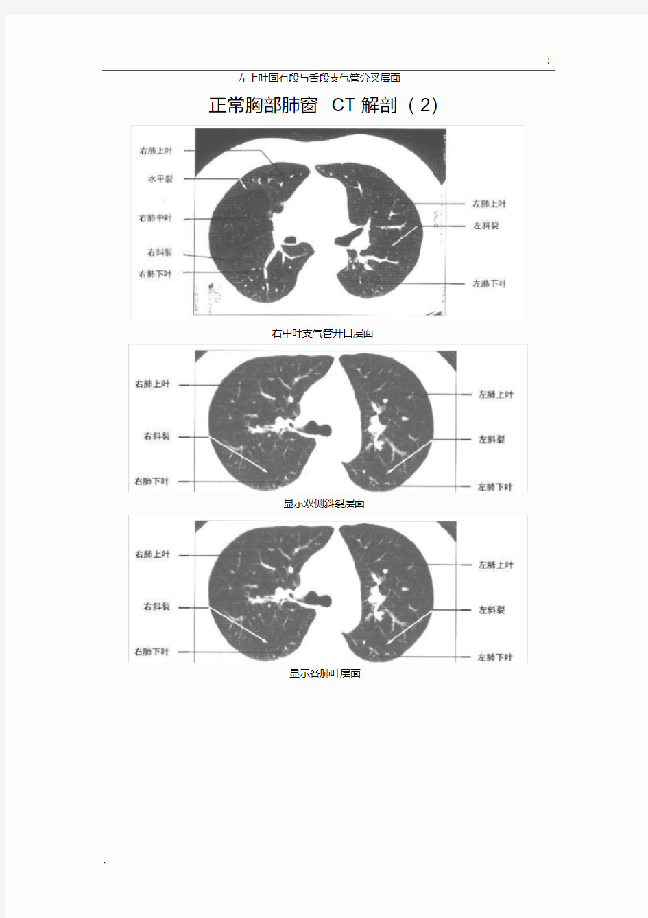 正常胸部CT解剖(肺窗和纵隔窗)