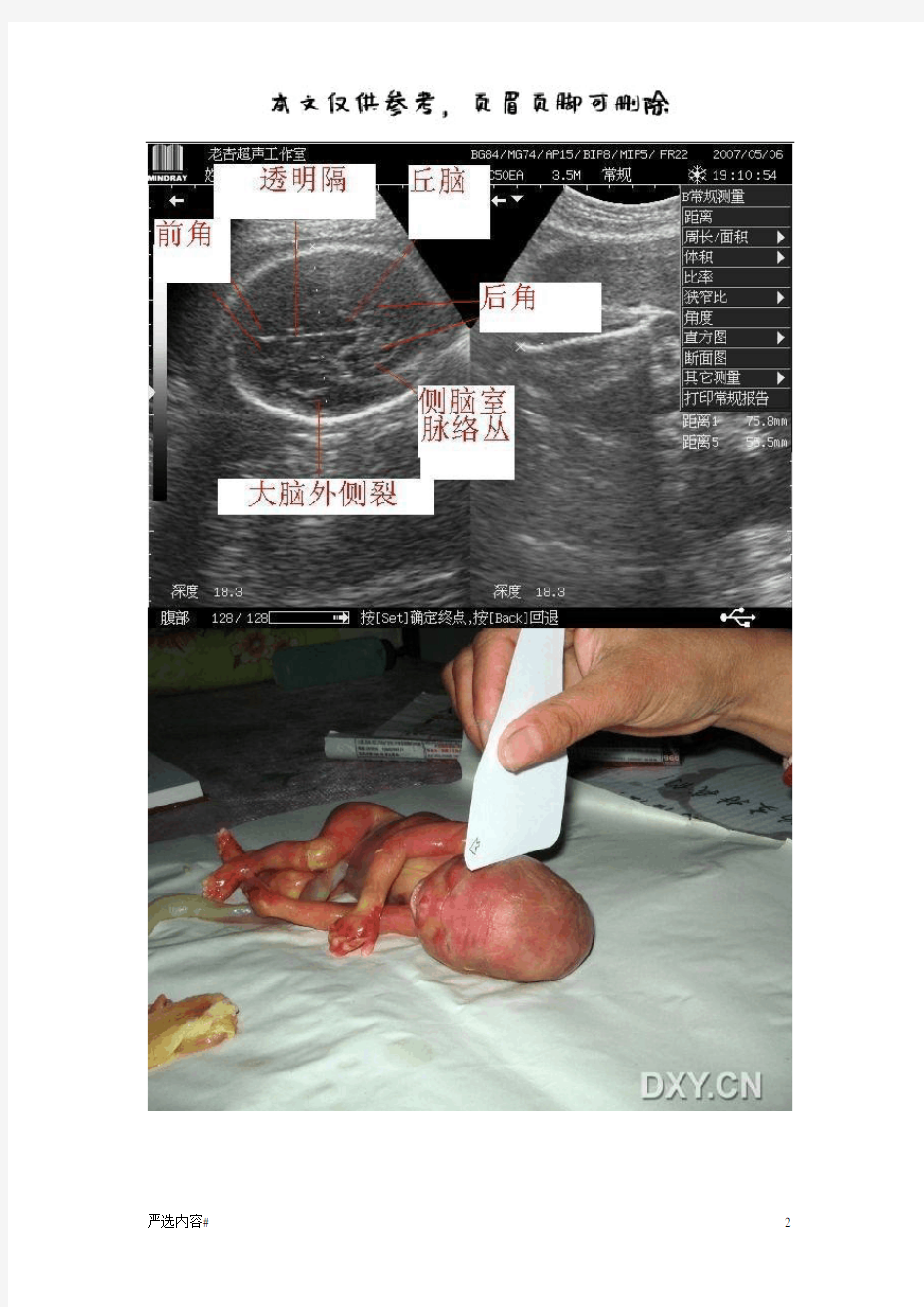 胎儿超声标准切面(参考资料)