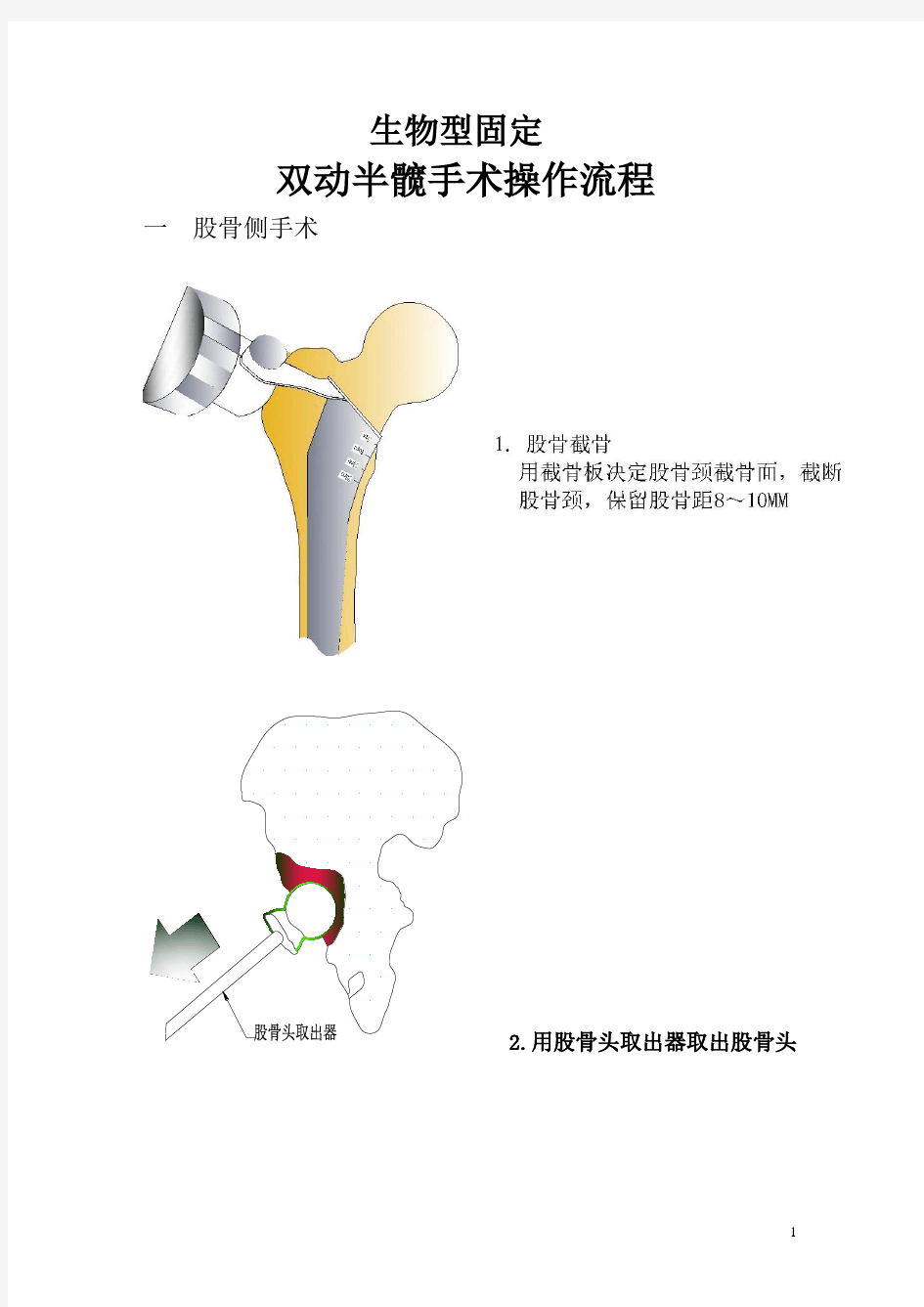 髋关节置换手术操作流程