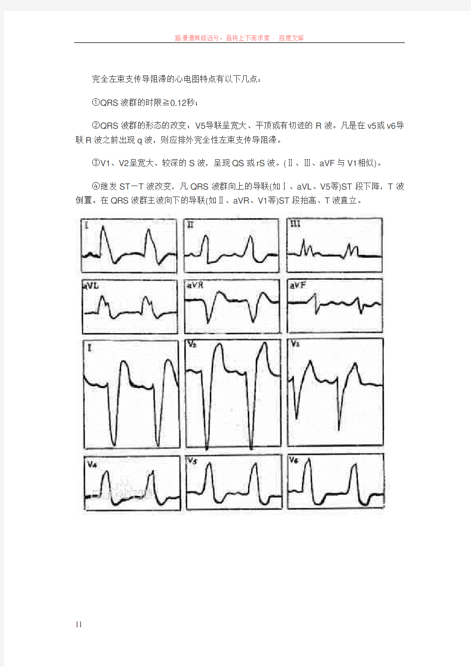 完全左束支传导阻滞与完全右束支传导阻滞心电图特点