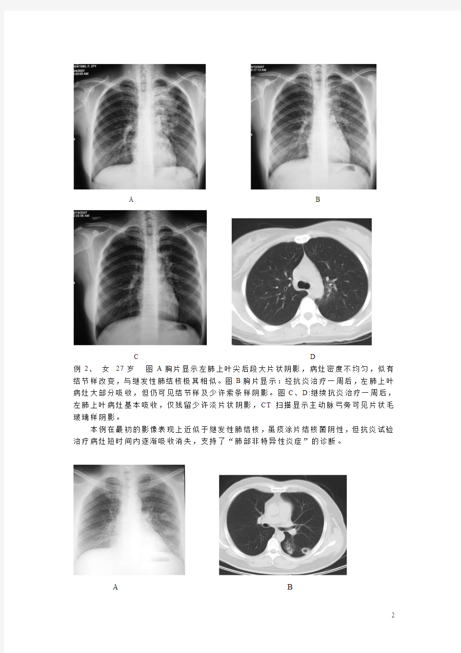 肺结核不典型影像学表现的分析与诊断