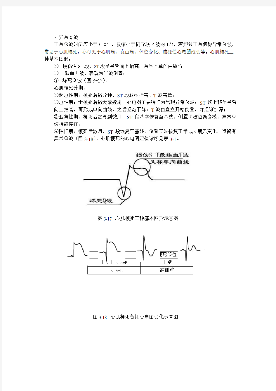 异常q波