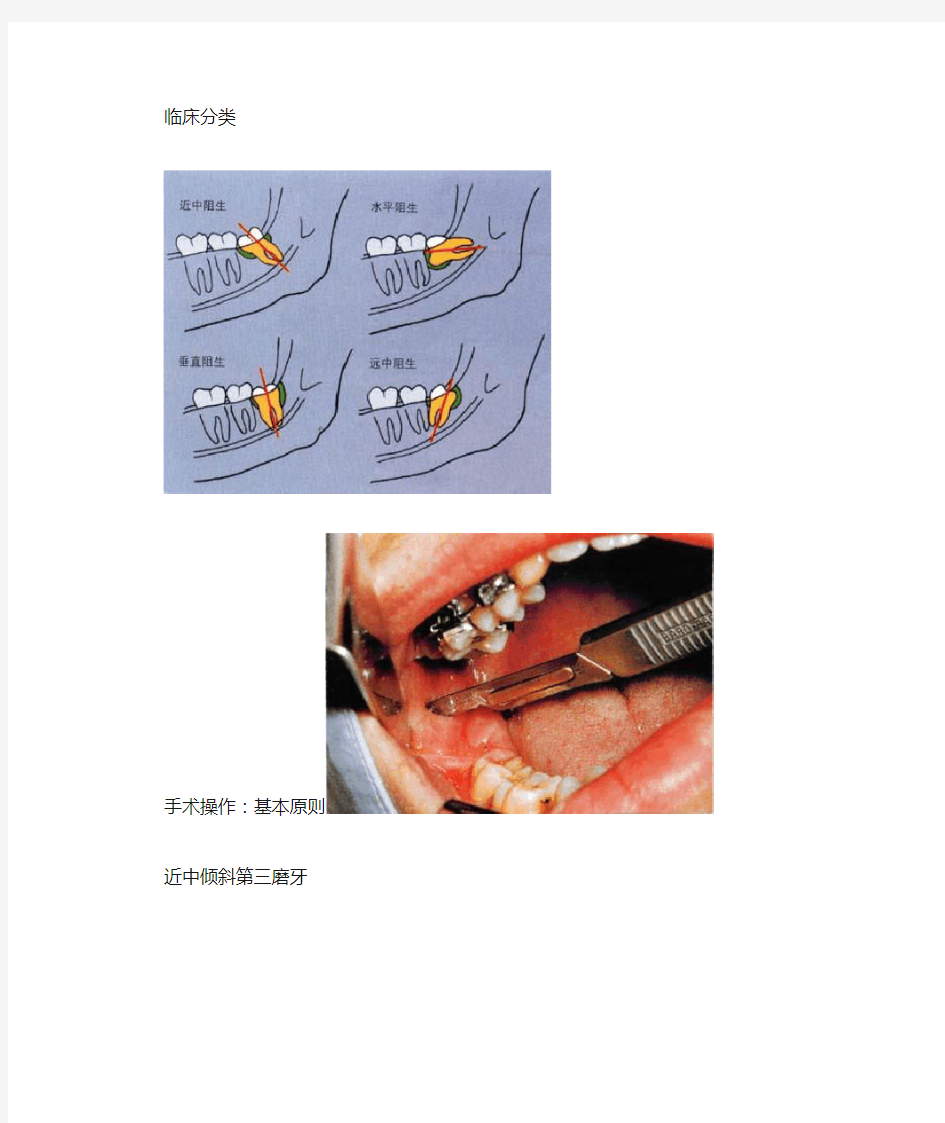 阻生第三磨牙拔除讲解