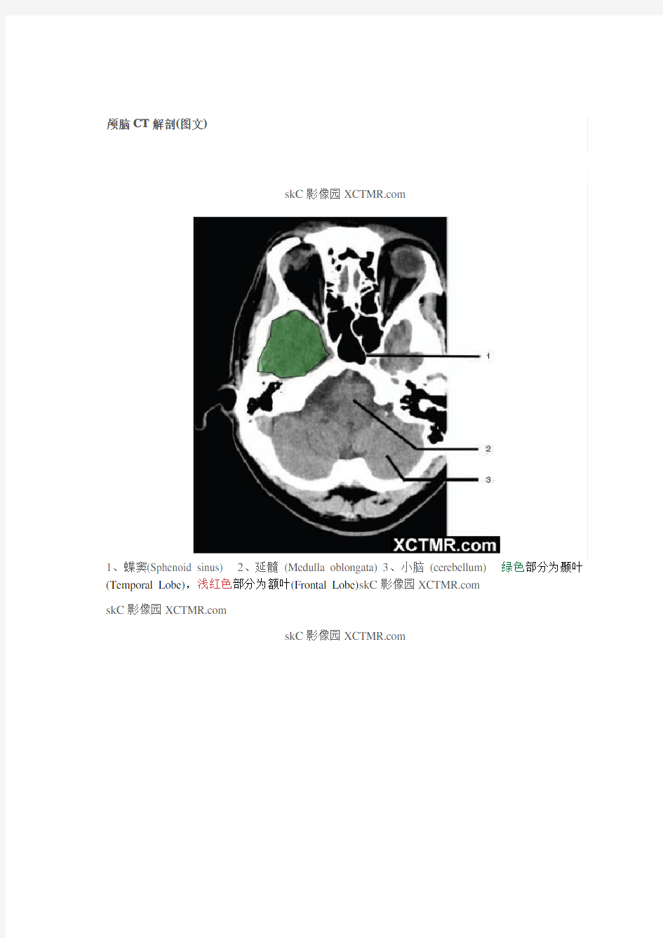 颅脑CT解剖(图文)