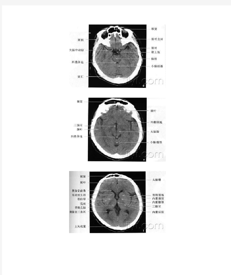 头部CT与MRI解剖图