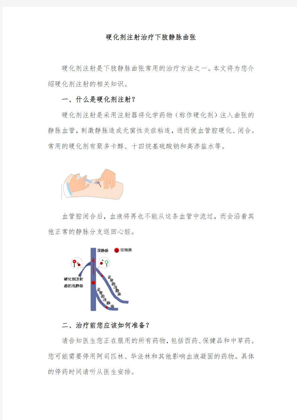 硬化剂注射治疗下肢静脉曲张