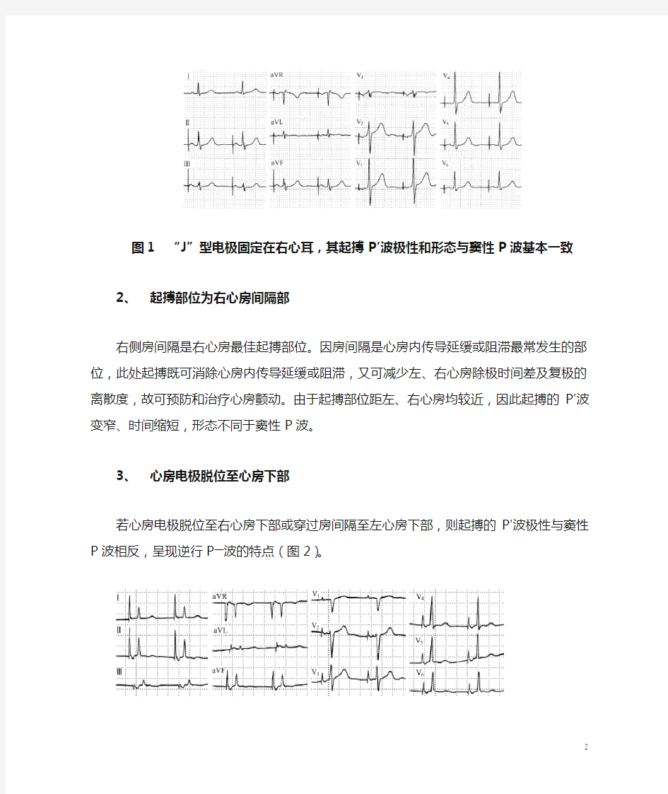 基础起搏心电图解读之四根据起搏P′、QRS′波形判断起搏部位