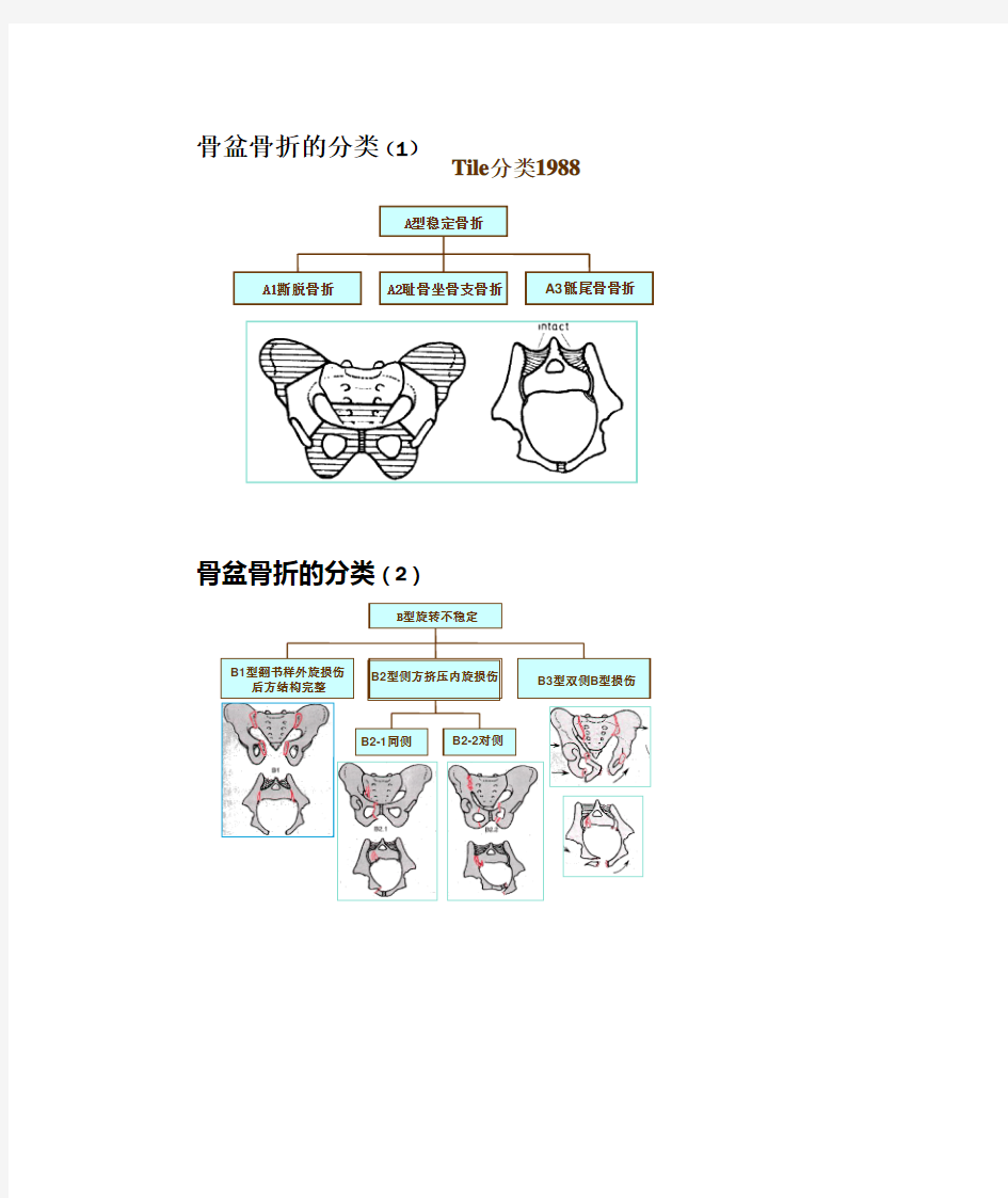 骨盆骨折分类及处理