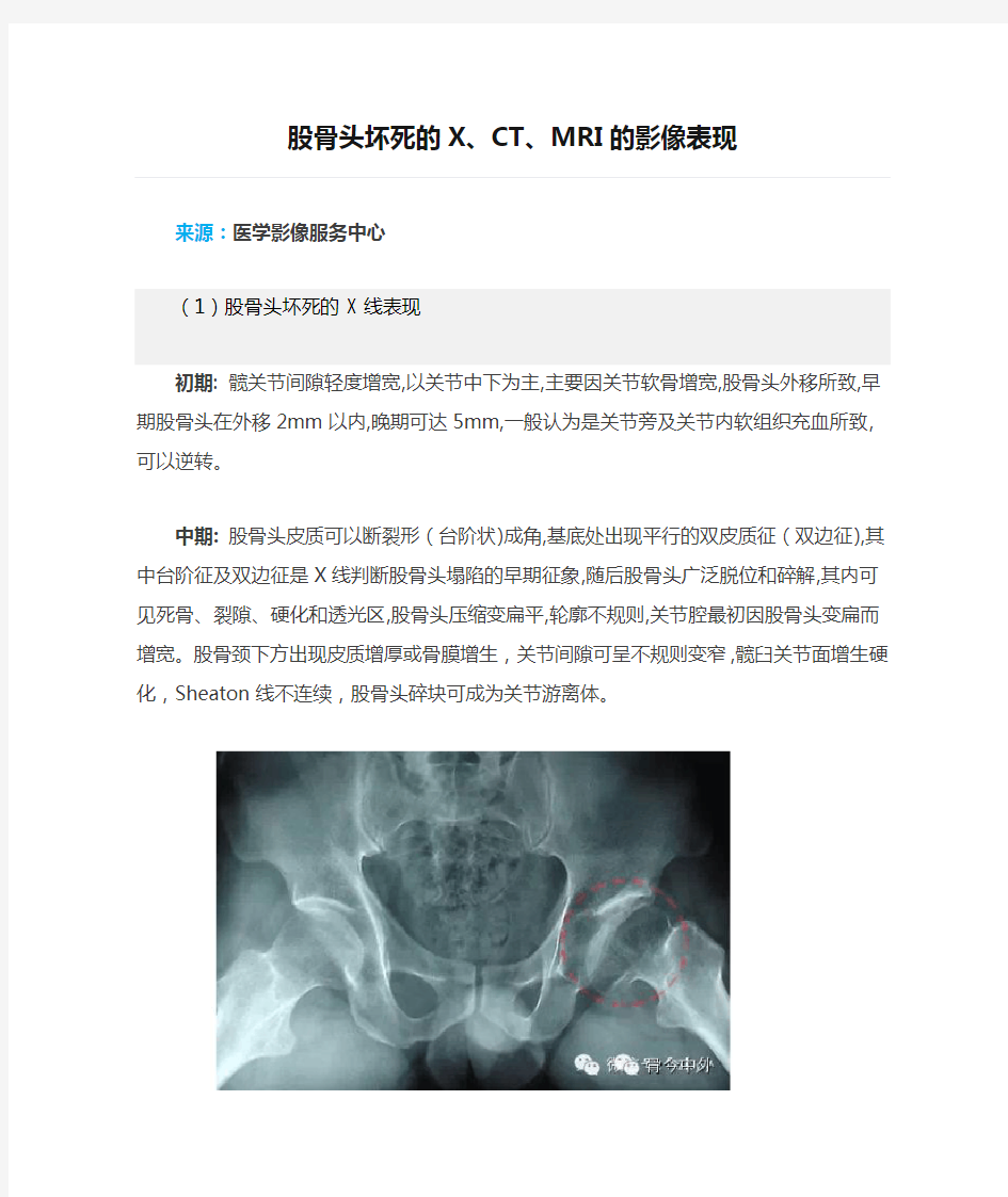 股骨头坏死的X、CT、MRI的影像表现