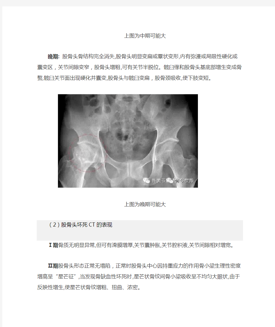股骨头坏死的X、CT、MRI的影像表现