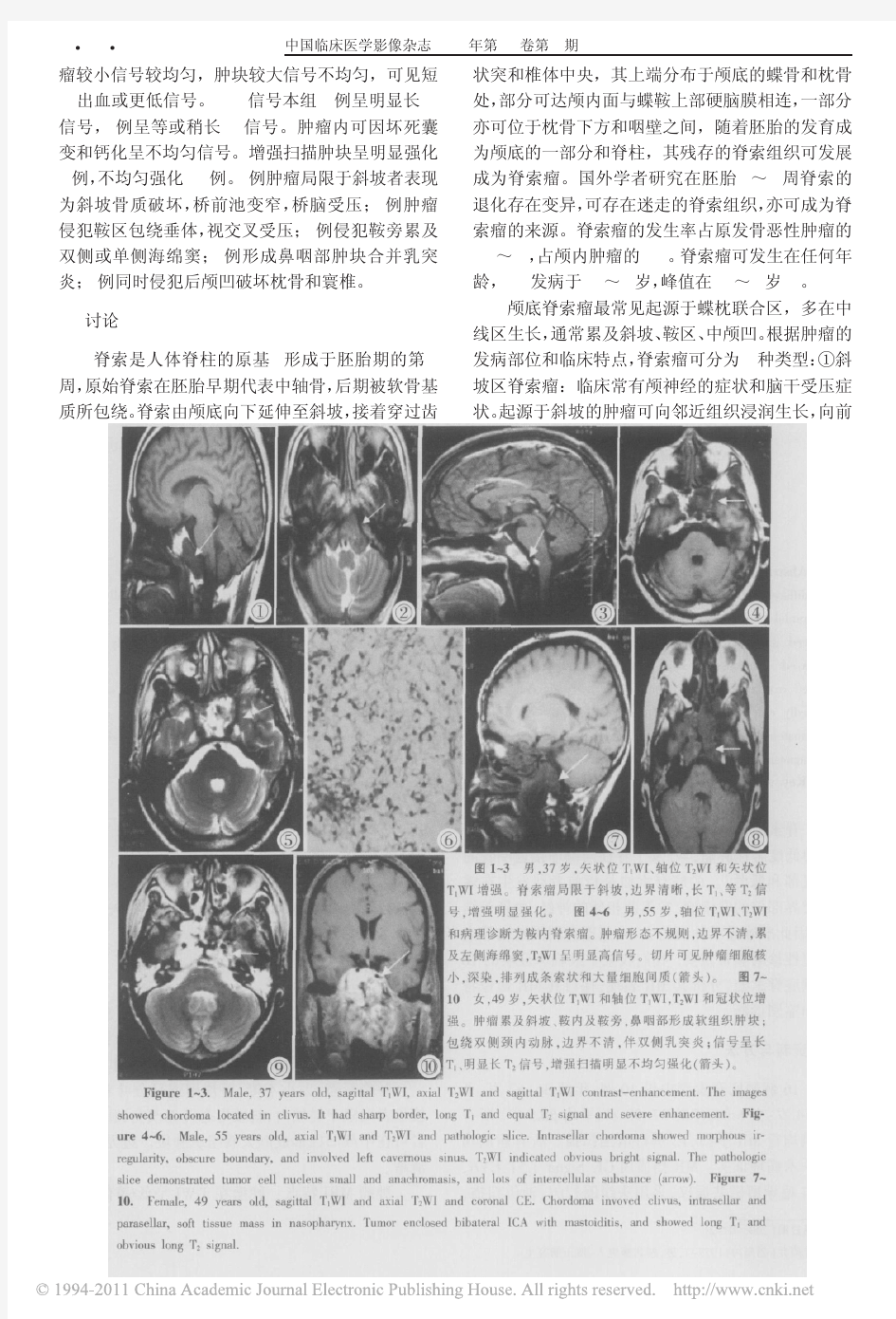 颅底脊索瘤的MR表现分析及鉴别诊断