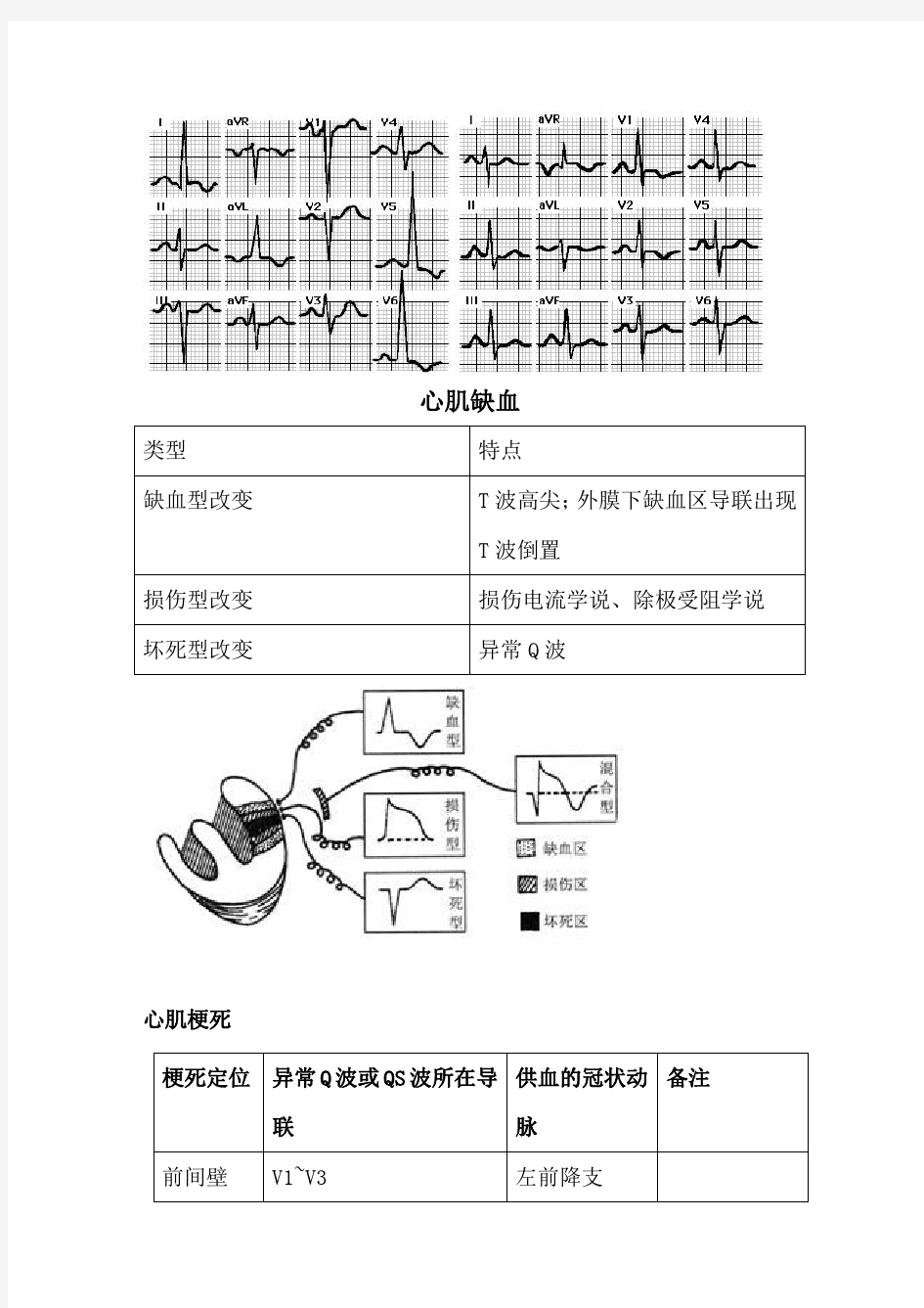 【临床诊断学】南方医科大学异常心电图总结