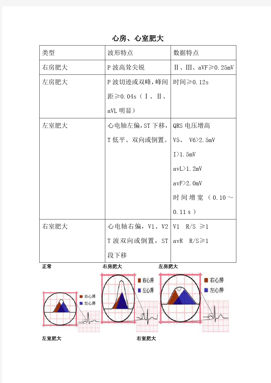 【临床诊断学】南方医科大学异常心电图总结