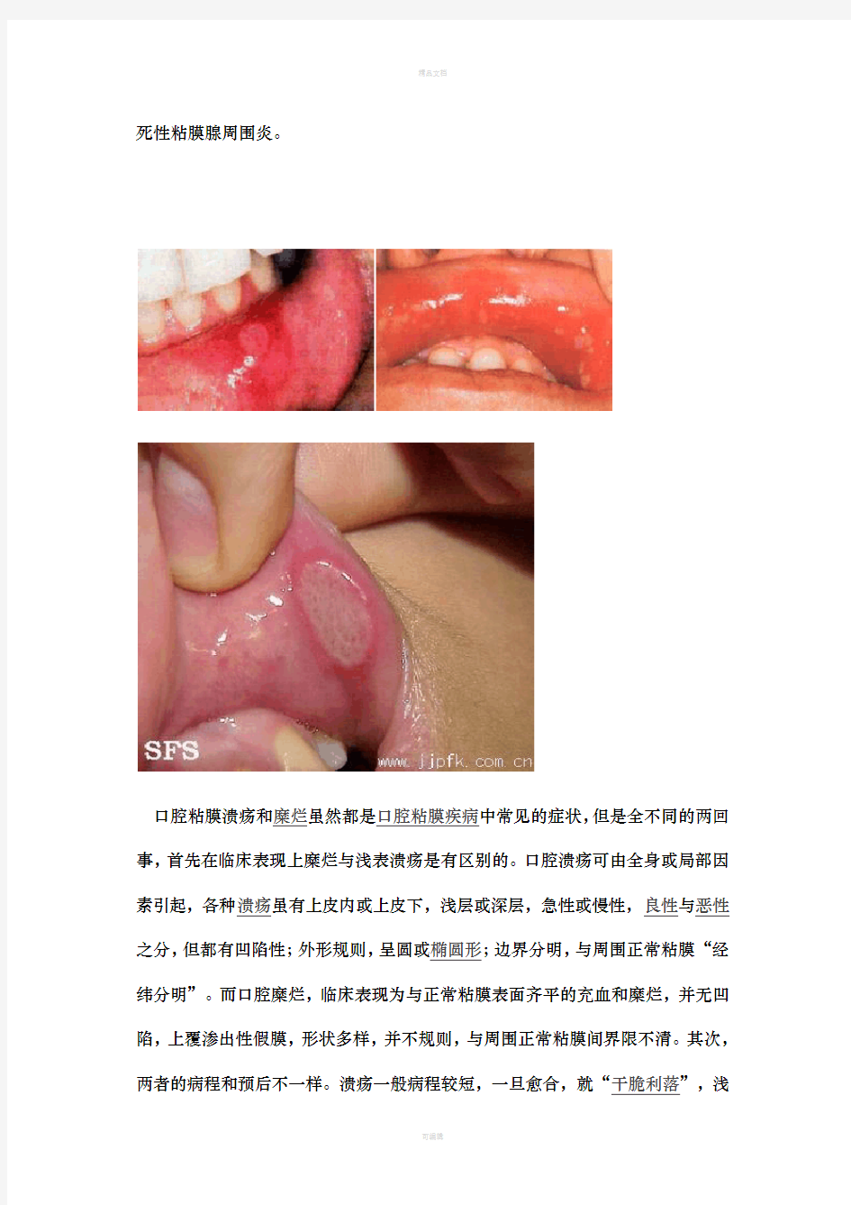 口腔溃疡的治疗方法与预防措施