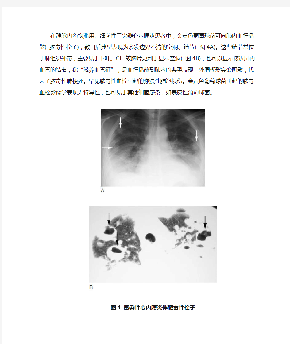 金葡菌肺炎